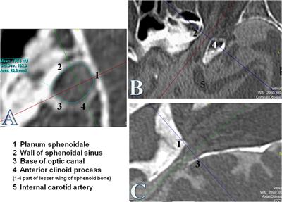 The Optic Canal: A Bottleneck for Cerebrospinal Fluid Dynamics in Normal-Tension Glaucoma?